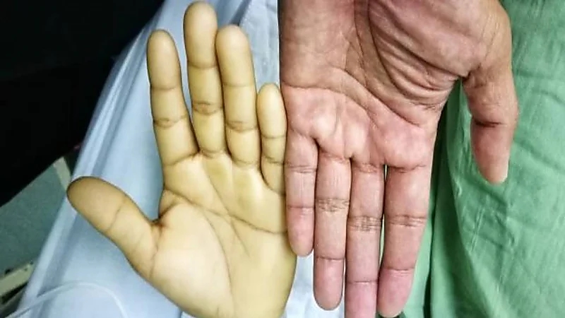 استشاري يوضح سبب الإصابة بمرض فقر الدم المنجلي "فيديو"