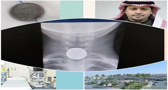 مستشفى " الملك سعود " تنقذ طفل ابتلع قطعة معدنية دون جراحة