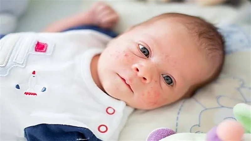 استخدام حليب الأم لعلاج حبوب الأطفال
