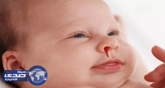 نصائح هامة لتجنب نزيف الأنف لدى الأطفال
