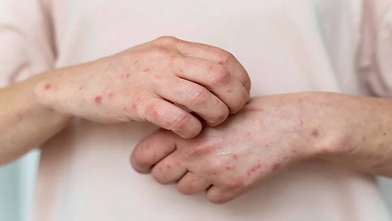 طرق تقليل ضرر الإكزيما خلال فصل الشتاء