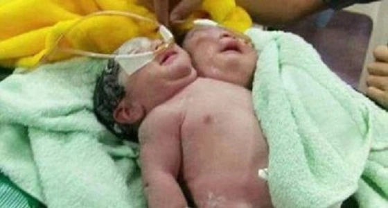 بالصور .. أم تضع توأم ملتصق وسط كثير من المخاوف