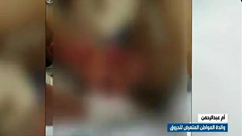 بالفيديو.. والدة المواطن المتعرض للحروق: مركز الإيواء تأخر في إسعاف "ابني"