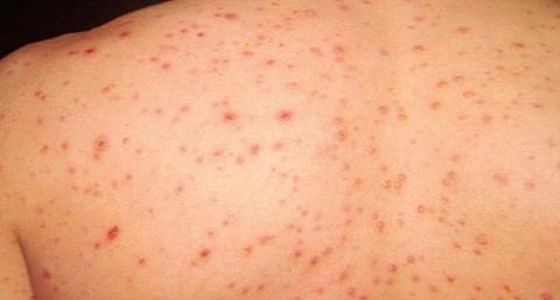 وفاة 11 شخصا لإصابتهم بـ " الحصبة " بالجزائر