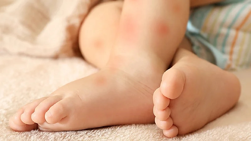 رجل يتهم طليقته بتعذيب ابنهما بعد إصابته بالحساسية