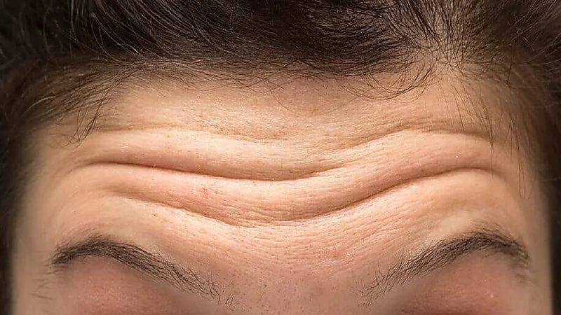نصائح للتخلص من تجاعيد الجبهة