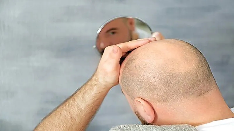 المياه المالحة من أسباب الصلع المبكر