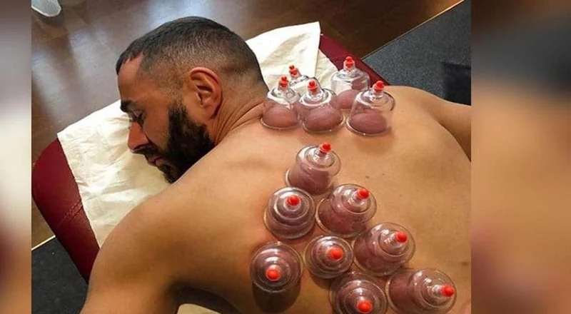 سبب لجوء الرياضيين لعمل الحجامة