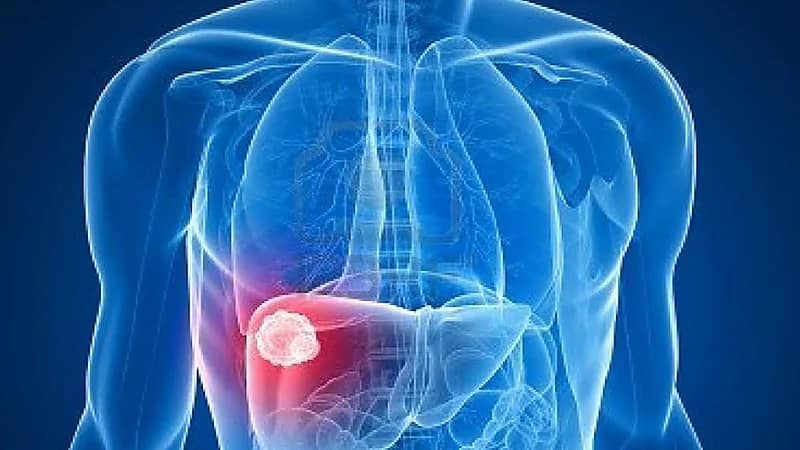 الصحة تكشف عن طرق انتقال مرض التهاب الكبد الوبائي "ج"