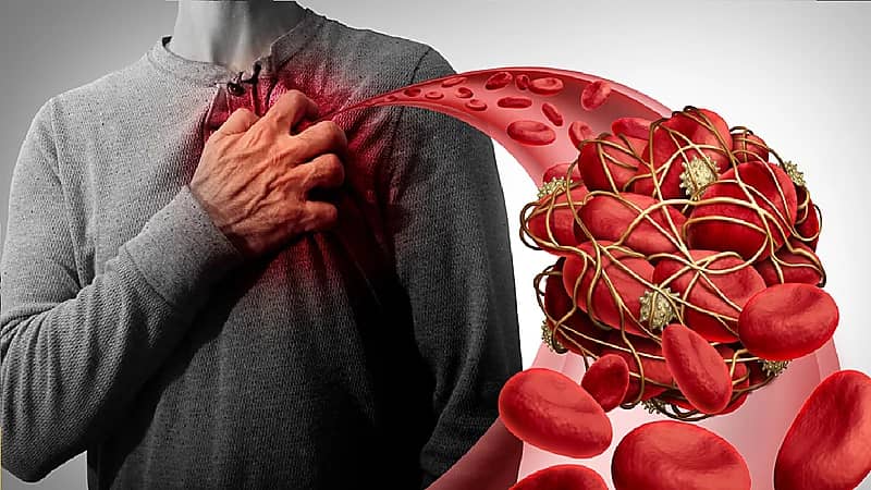 بالفيديو .. مختص يوضح عامل وراثي يزيد من مخاطر الإصابة بانسداد الشرايين