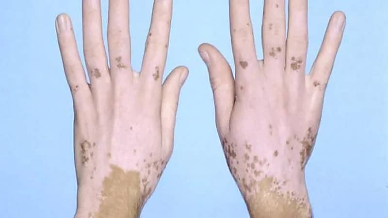 بالفيديو.. استشاري يكشف عن آخر الأساليب الطبية لعلاج "البرص والبهاق"