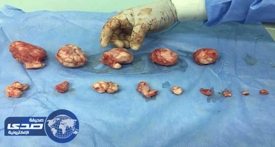 استئصال 10 كتل أورام ليفية من رحم مريضة بمستشفى بيشة