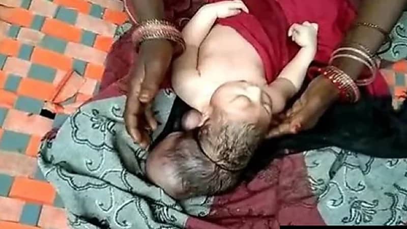 ولادة طفل بـ 3 رؤوس