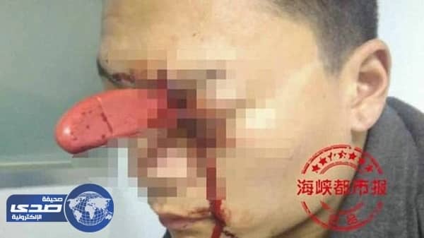 بالصور.. صينية تغرس سكيناُ بعين زوجها بسبب خلافات بينهما