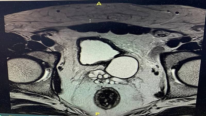 تسجيل اول حالة "لمتلازمة زينر الثلاثية" في مكة