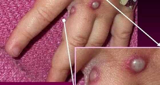 إحذر.. فيروس غامض يمكنه قتل 10 % من سكان العالم