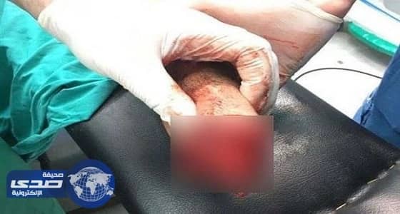 4 أشقاء يقطعون يد شاب بالقاهرة بسبب هاتف محمول