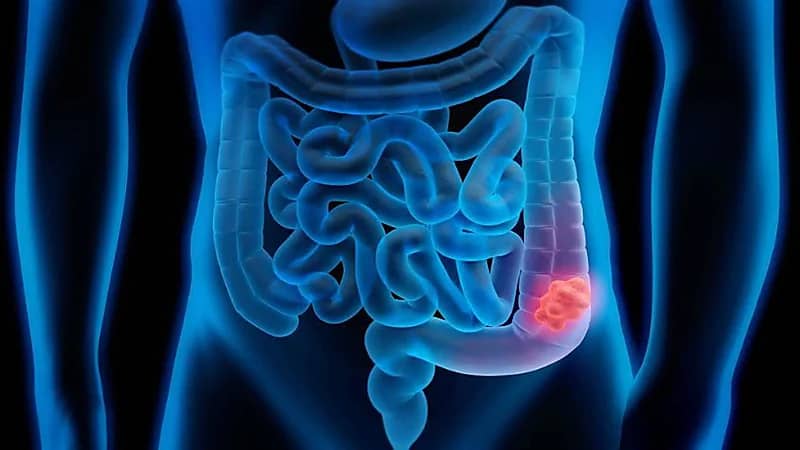طرق الوقاية من الإصابة بسرطان القولون