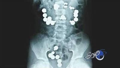 رضيع ابتلع 42 مغناطيساً