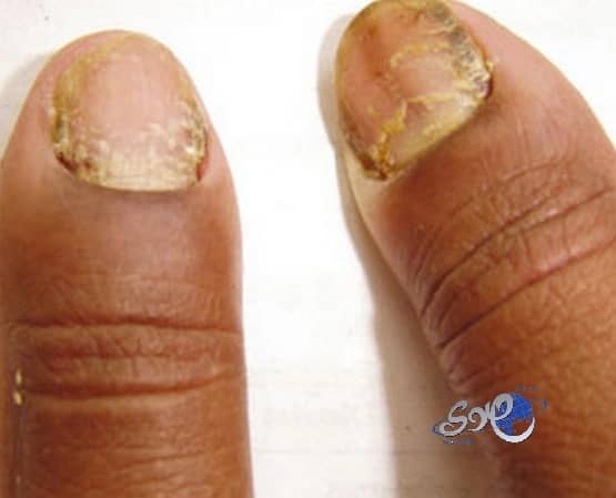 "الفطريات".. ملوثات تسبب الأمراض والوفاة