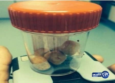 استخراج حصوات من مثانة طفل ذو 3 سنوات