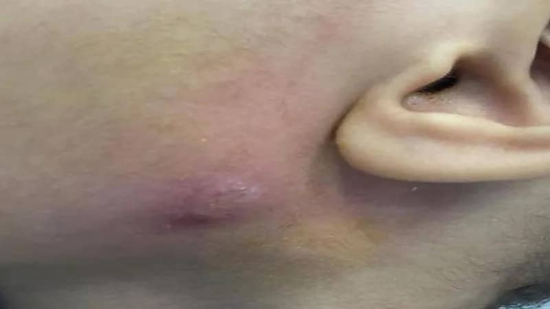 استخراج دودة من "خد" طفل في الطائف