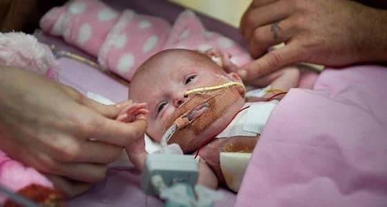 بالفيديو.. معجزة إنقاذ رضيعة ولدت بقلب خارجي