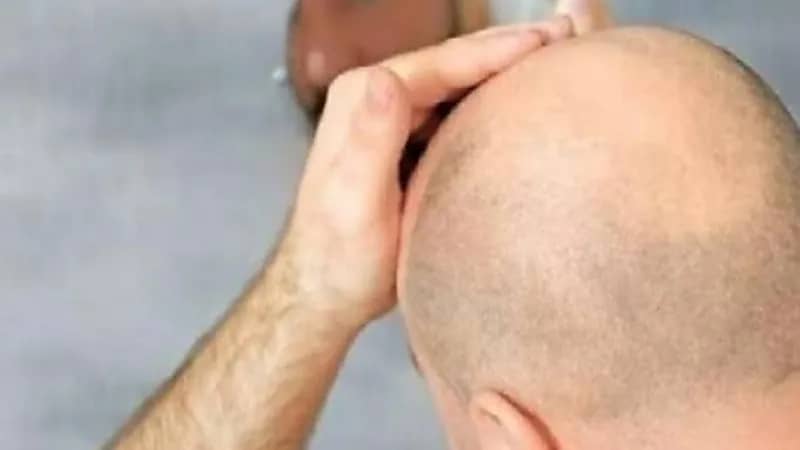 اكتشاف جديد يساعد في علاج الصلع