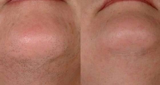 وصفة روسية بمكونان فقط  للتخلص من شعر الوجه الزائد