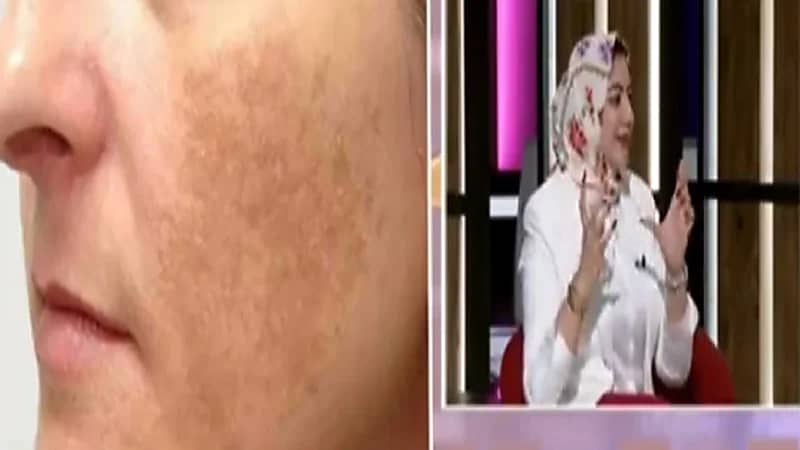 هل الليزر يعالج تصبغات البشرة والنمش ؟.. "أخصائية جلدية" تجيب