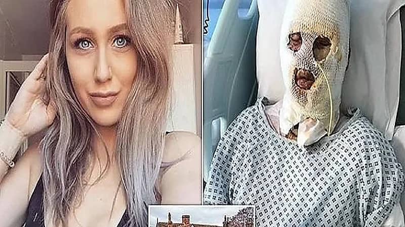 مزحة تتسبب في تشويه وجه فتاة حسناء