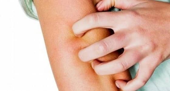 اشتباه في 3 حالات جرب في ابتدائية للبنات بمكة