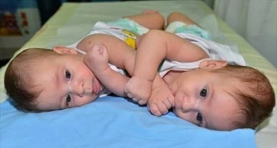 إجراء 44 عملية لفصل توائم سيامية من 20 دولة في المملكة