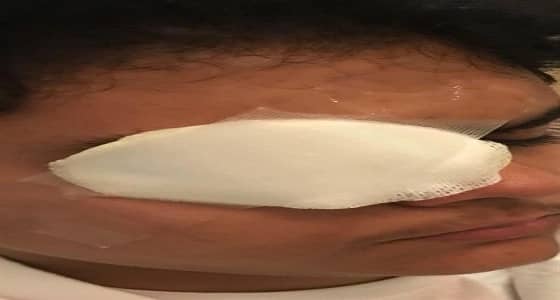 معلم يمزق غشاء عين أحد الطلاب بالبدائع