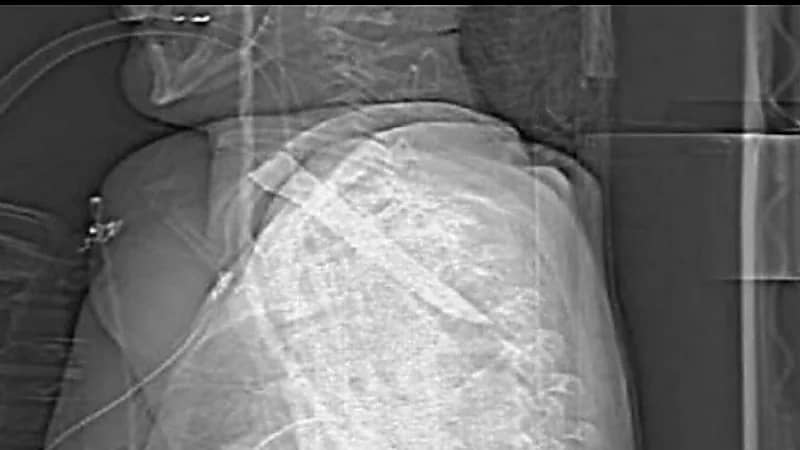 رجل ينجو بأعجوبة بعد طعنة بسكين في عنقه