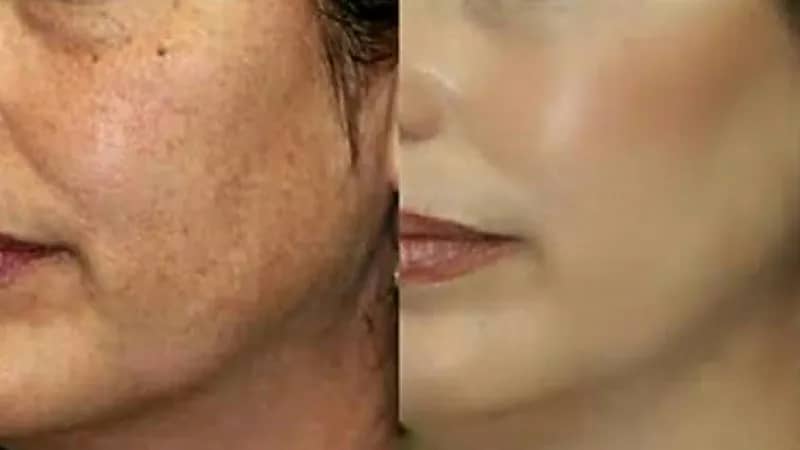 خطوات لتوحيد لون البشرة والتخلص من البقع