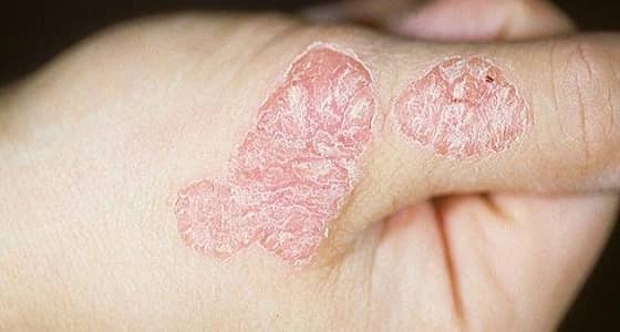 " النمر " يوجه نصيحة لمرضى الصدفية