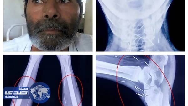 استخراج 75 مسماراً من جسد رجل بالهند