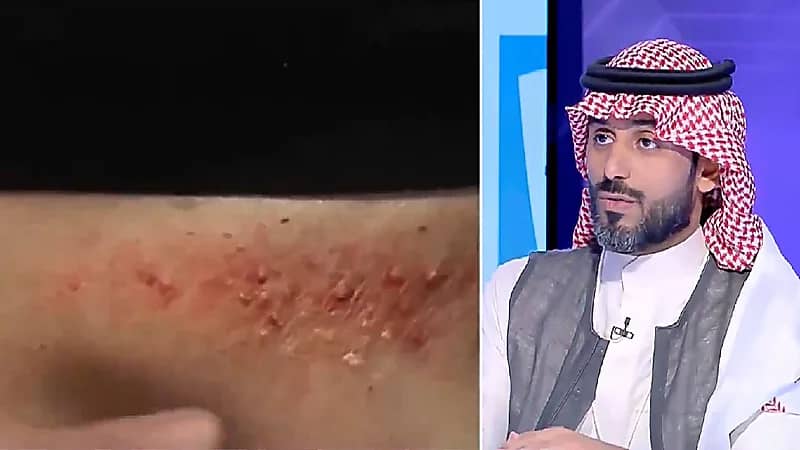 بالفيديو.. استشاري: الحزام الناري أساسه العنقز