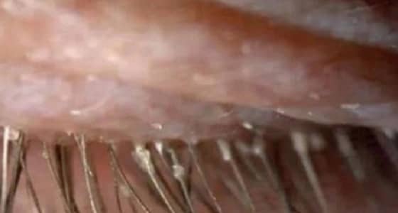 مستعمرات لحشرة " العث " برموش سيدة صينية