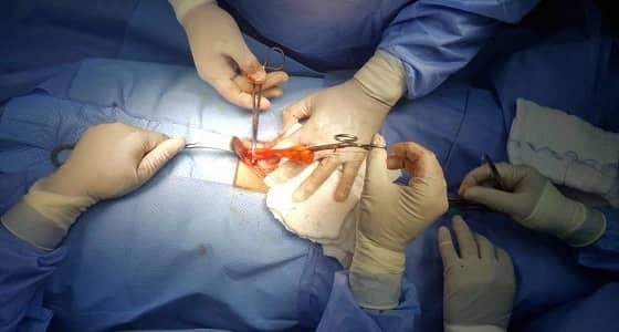 نجاح عملية " فتق إربي " بمستشفى بدر