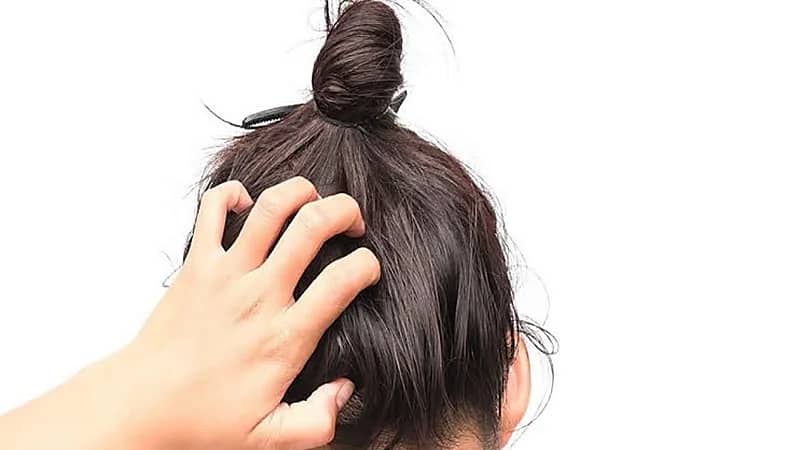 أشياء تؤدي إلى الإصابة بالقشرة وحكة الرأس