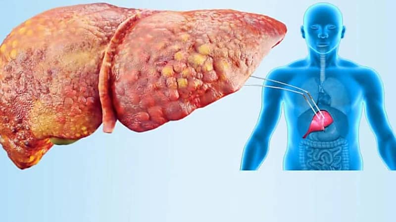 أسباب الإصابة بمرض الكبد الدهني غير الكحولي