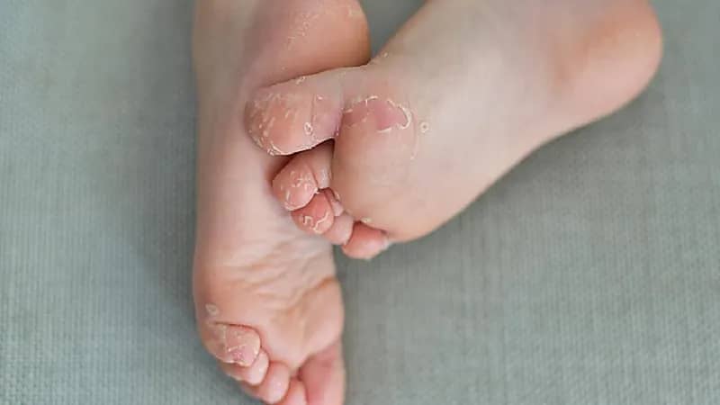 أسباب شائعة تؤدي لتقشر القدمين