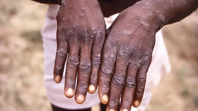 بالفيديو.. استشاري: من فوق 47 عاما قد يحتاجون لجرعات تنشيطة ضد جدري القردة