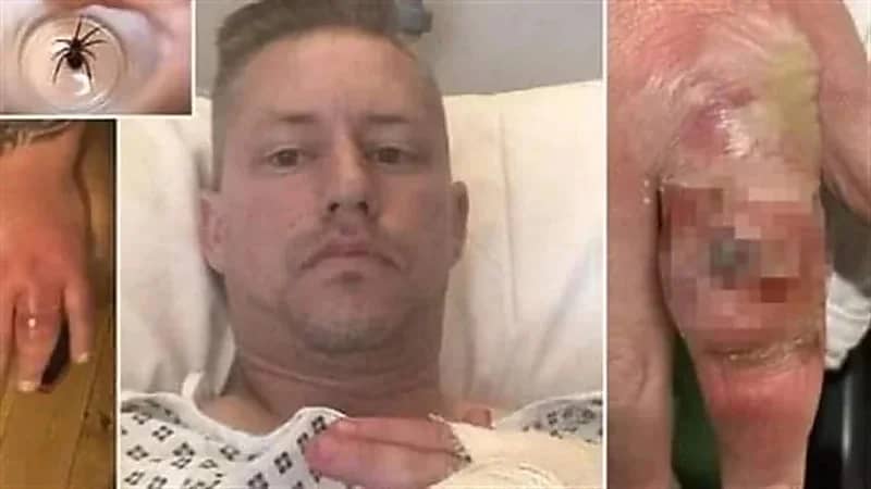لدغة عنكبوت مميتة تسمم جسد رجل