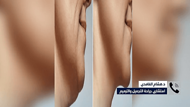 استشاري:لم يثبت علميا إسهام الهواتف والأجهزة الذكية في تكوين "الذقن المزدوج" 