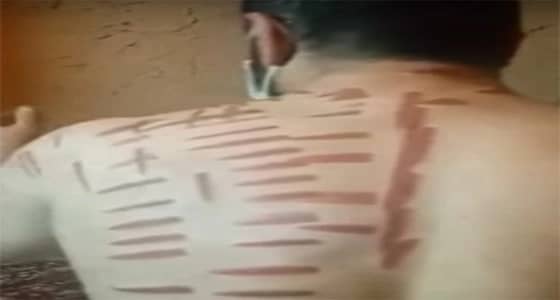 100 ألف ريال والسجن 6 أشهر عقوبة منتظرة لمدعي العلاج بالكي