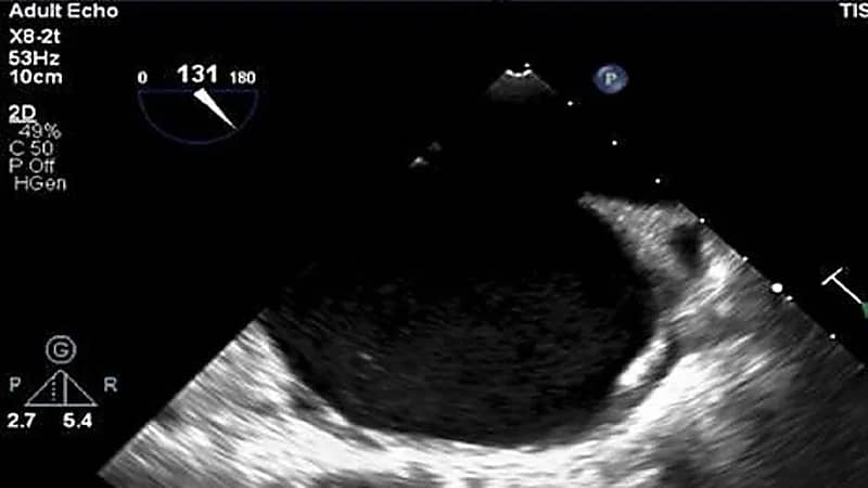 إنقاذ حياة مريضة حامل تعاني من القلب