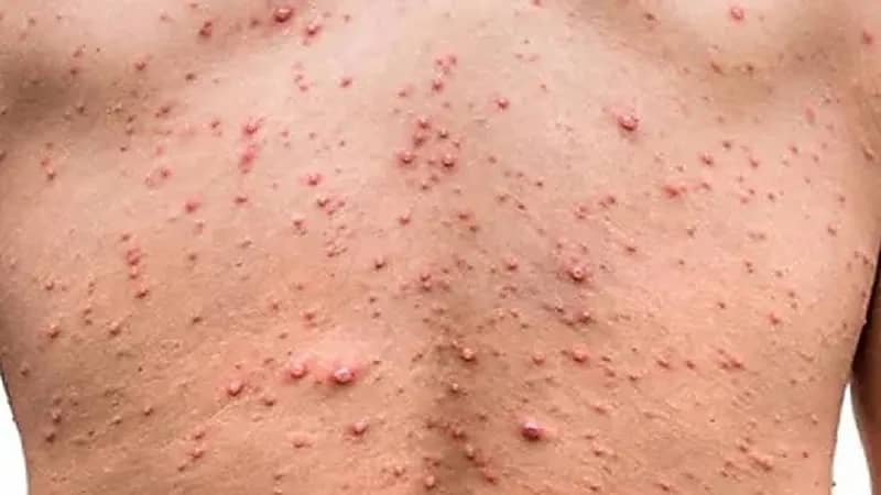 أمريكا تطالب المثليين والمثليات بالتسجيل للحصول على لقاحات جدري القرود